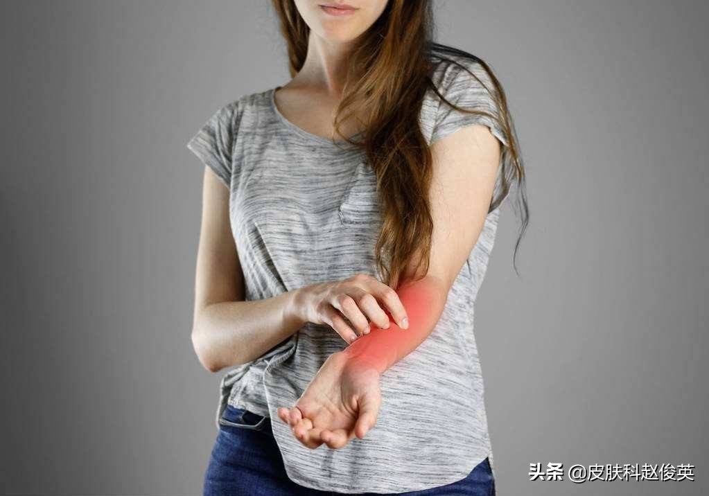 挠痒导致皮炎用什么药,神经性皮炎瘙痒挠坏了皮肤怎么办