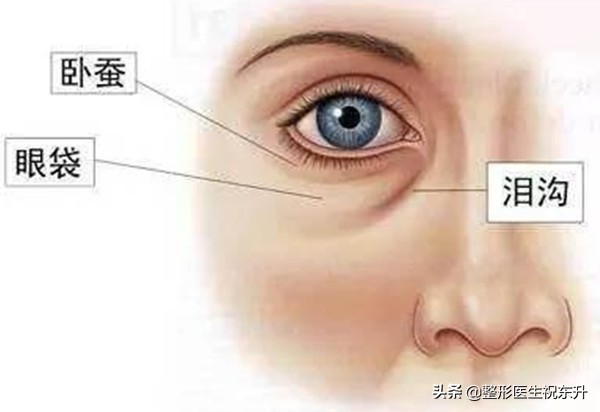 有眼袋、泪沟该怎么办？医生为你支个招