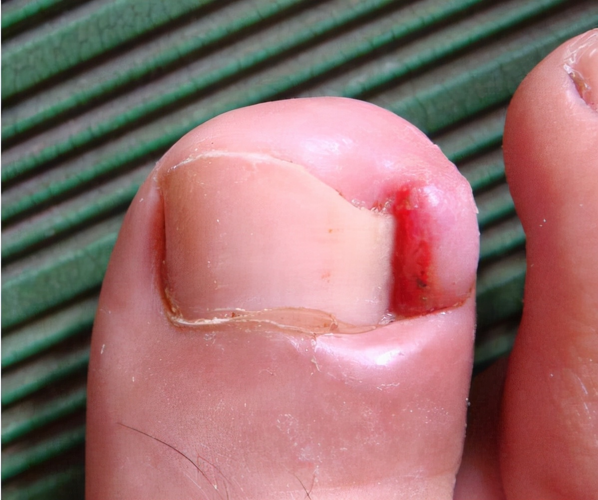 脚趾甲长进肉里会痛怎么办甲沟炎,脚趾甲老往肉里钻一碰还疼