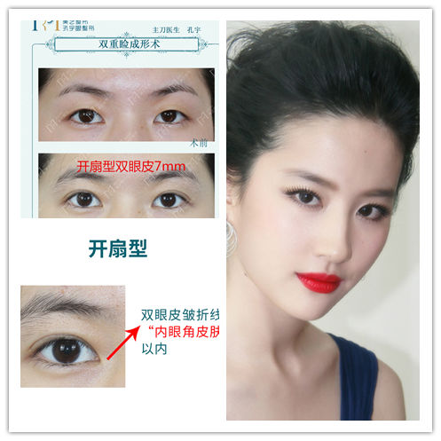 最好看的四种双眼皮内双,三种双眼皮哪种效果好