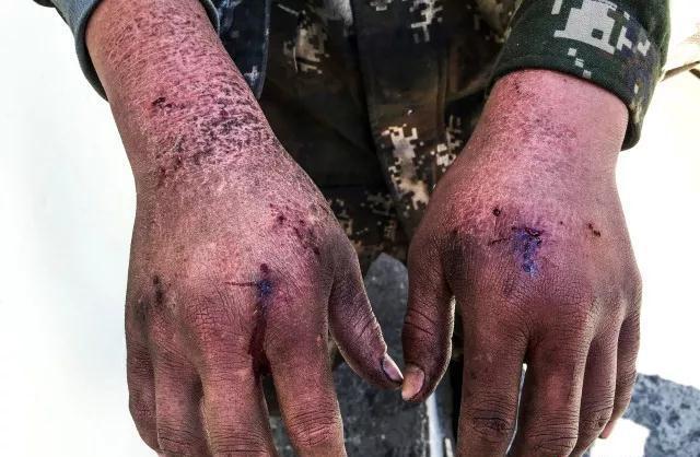 为什么液氮不会冻伤,液氮冻伤要赔多少钱