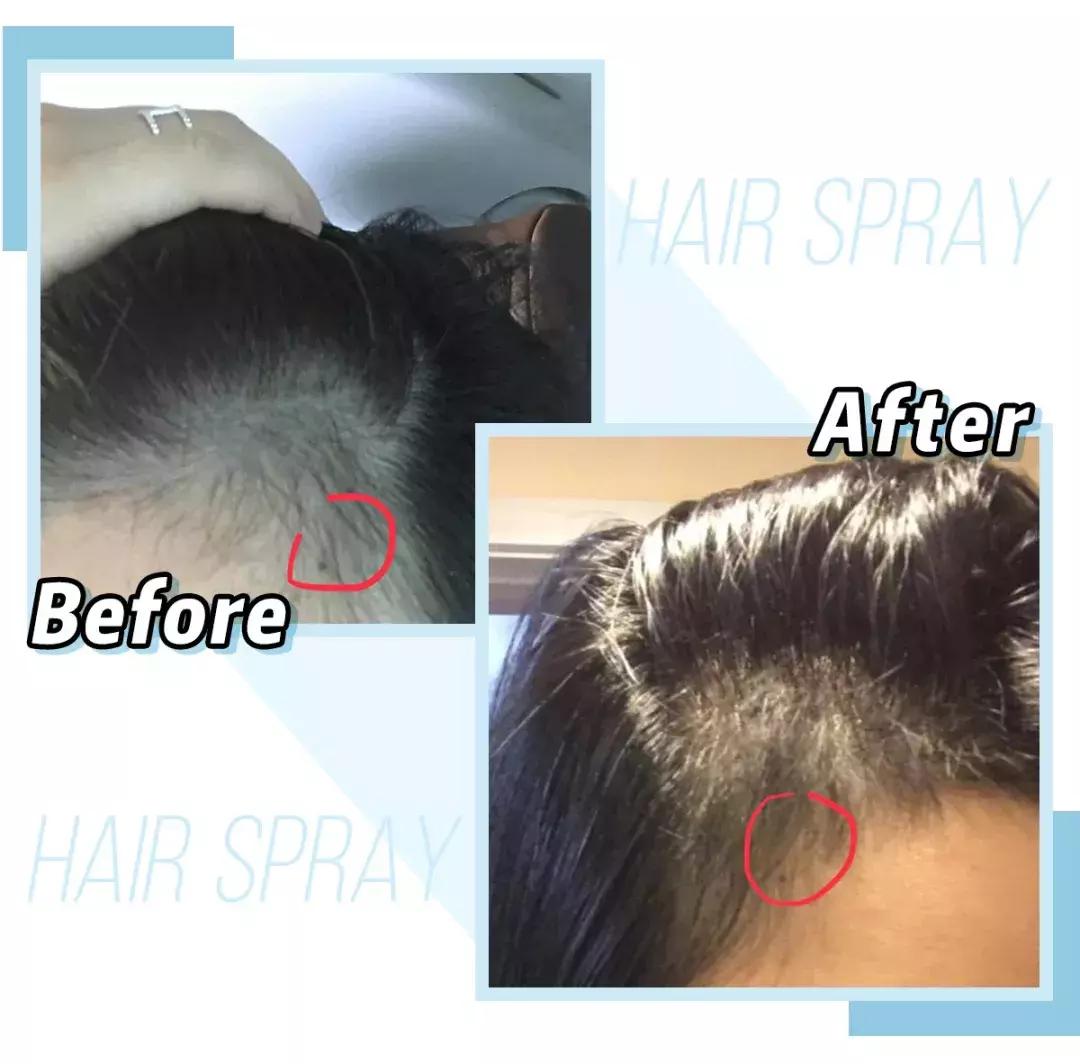 赵丽颖秃头照,赵丽颖秃顶原因