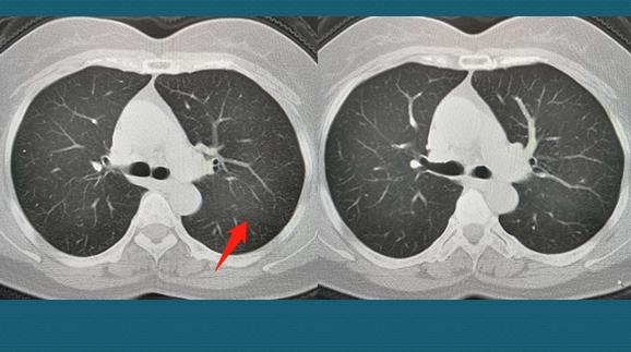 两名病情好转的心冠患者,轻度病毒性肺炎20天快好了