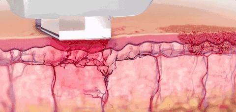 漾肤光子嫩肤,夏天适合做光子嫩肤如何护理