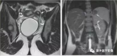 子宫发育异常,应想到的6大类常见畸形
