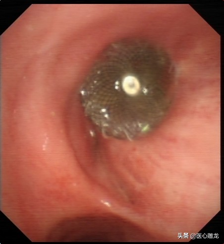 肺癌首次化疗后咳血痰严重,肺癌术后断断续续咳粉红色痰