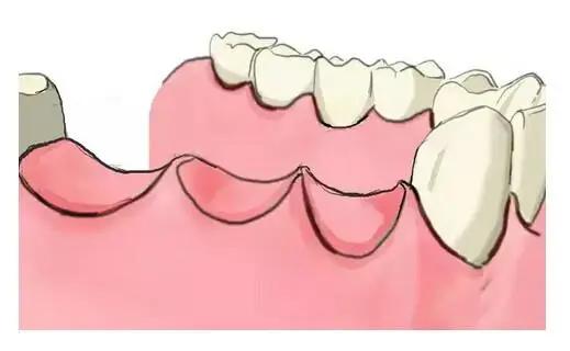 传统的种植牙和即刻种牙的区别,什么是种牙方法