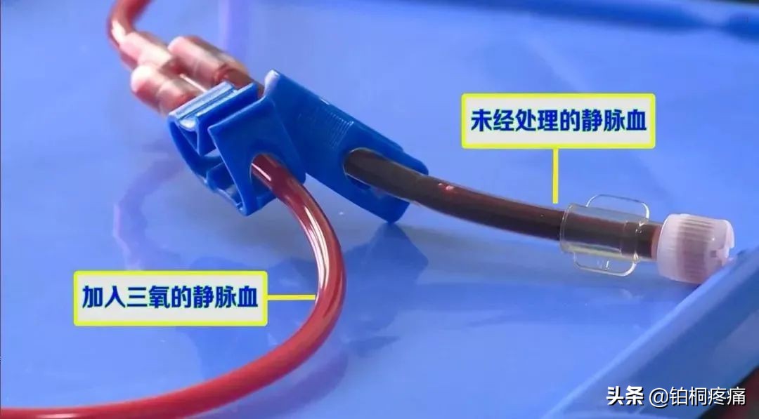 超氧自体血回输疗法是治什么病的,三氧自体血回输疗法简介