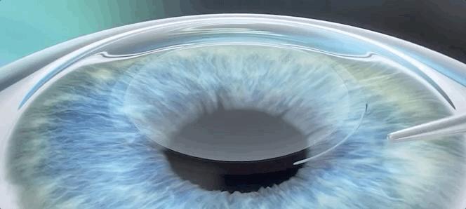 激光治疗近视什么原理,激光矫正是什么原理