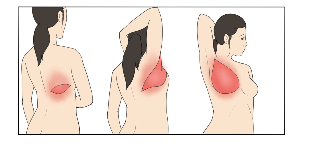 乳腺癌手术后乳房有鼓包,乳腺癌术后腋窝鼓包无痛怎么回事