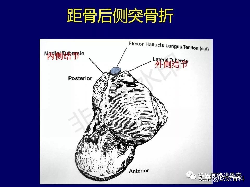 距骨骨折的治疗原则,距骨骨折如何调理