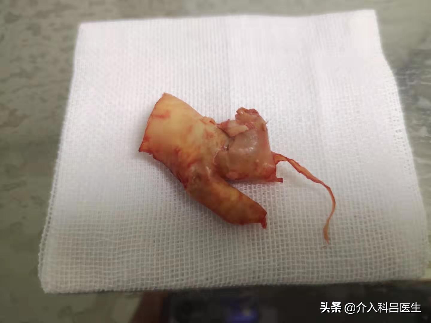 86岁左侧颈内动脉狭窄怎么办,75岁颈动脉狭窄81%咋样治疗