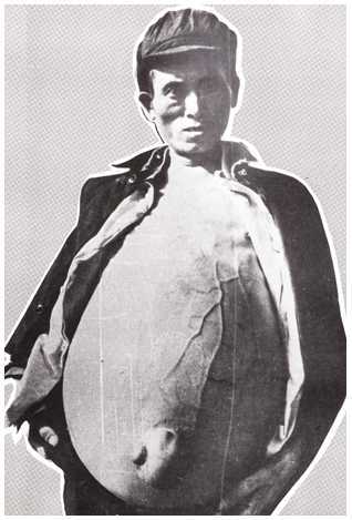 血吸虫会让肚子变大吗,血吸虫为何导致大肚子