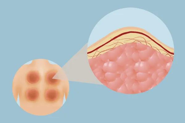 拔火罐的印子怎样快速去掉,拔火罐的印子怎样快速消除
