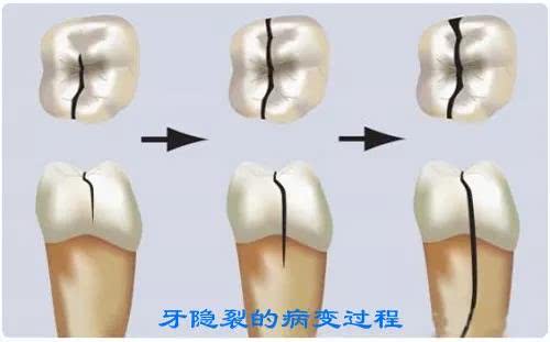 牙齿被牙刷磨出一条缝怎么补,牙齿保持器裂了一条缝能修补吗