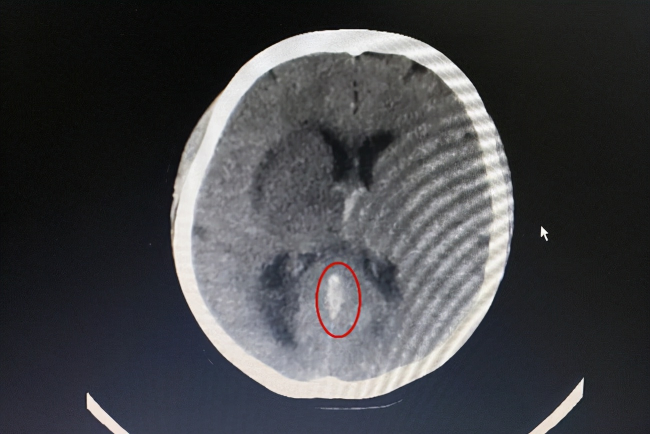 长期吃避孕药，女子脑血管“堵”了！避孕药吃多，会有什么后果？