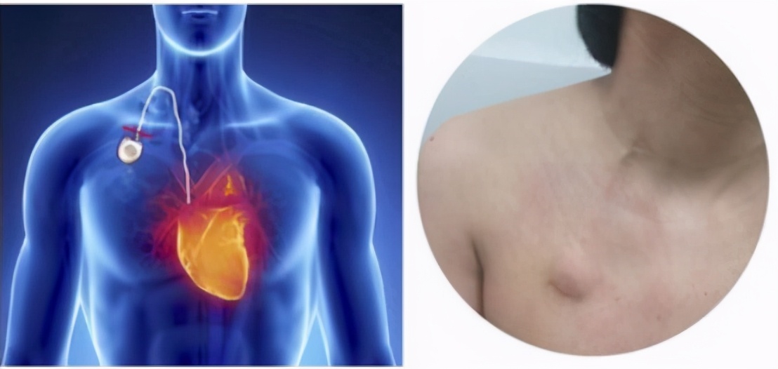 腹腔输液港植入术,植入式专用静脉输液港