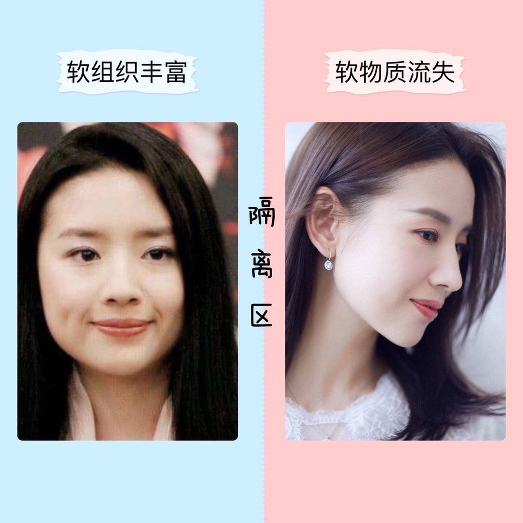 按摩脸部可以消除法令纹?郑爽、范冰冰亲自示范,我劝你别按了