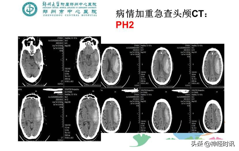 静脉溶栓怎么引起的,静脉相关并发症的预防及处理