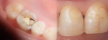 嘎嘣脆的牙齿,牙齿碎裂因为什么