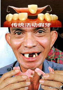 活动假牙排牙制作,下牙义齿制作