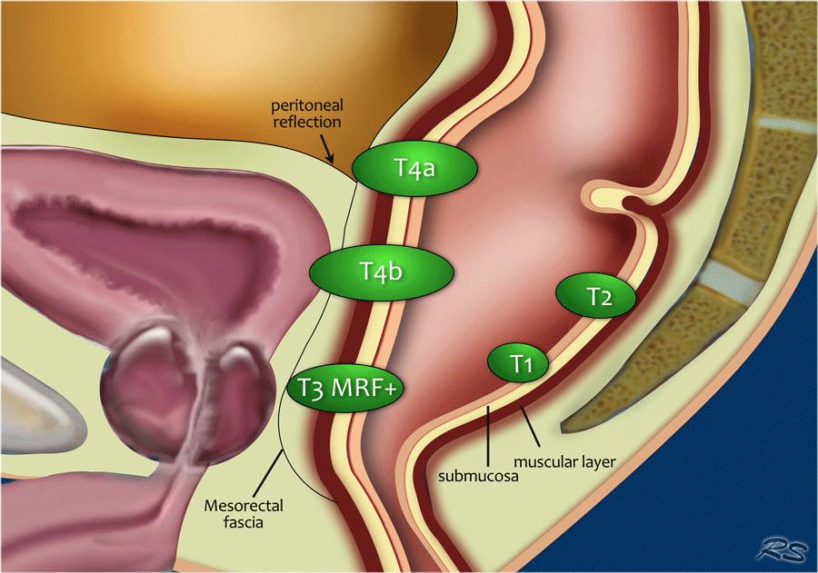 直肠癌“保肛”，你必须知道的知识