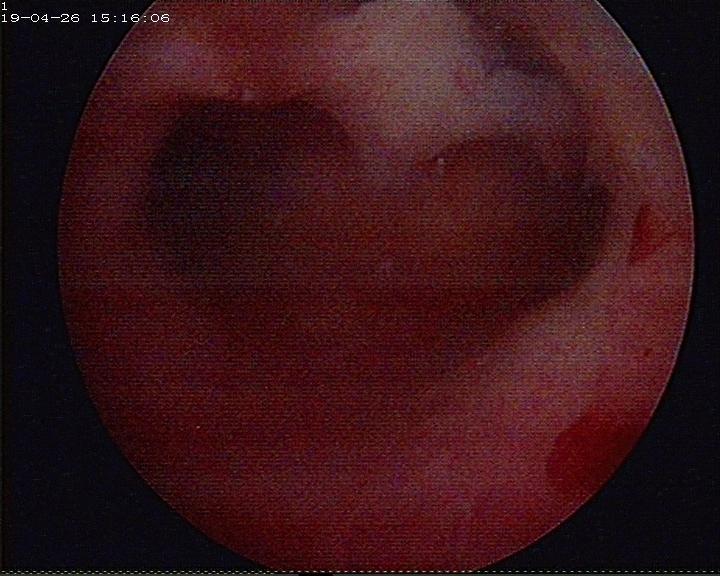 战胜胎停——复发性流产的治愈病例之一