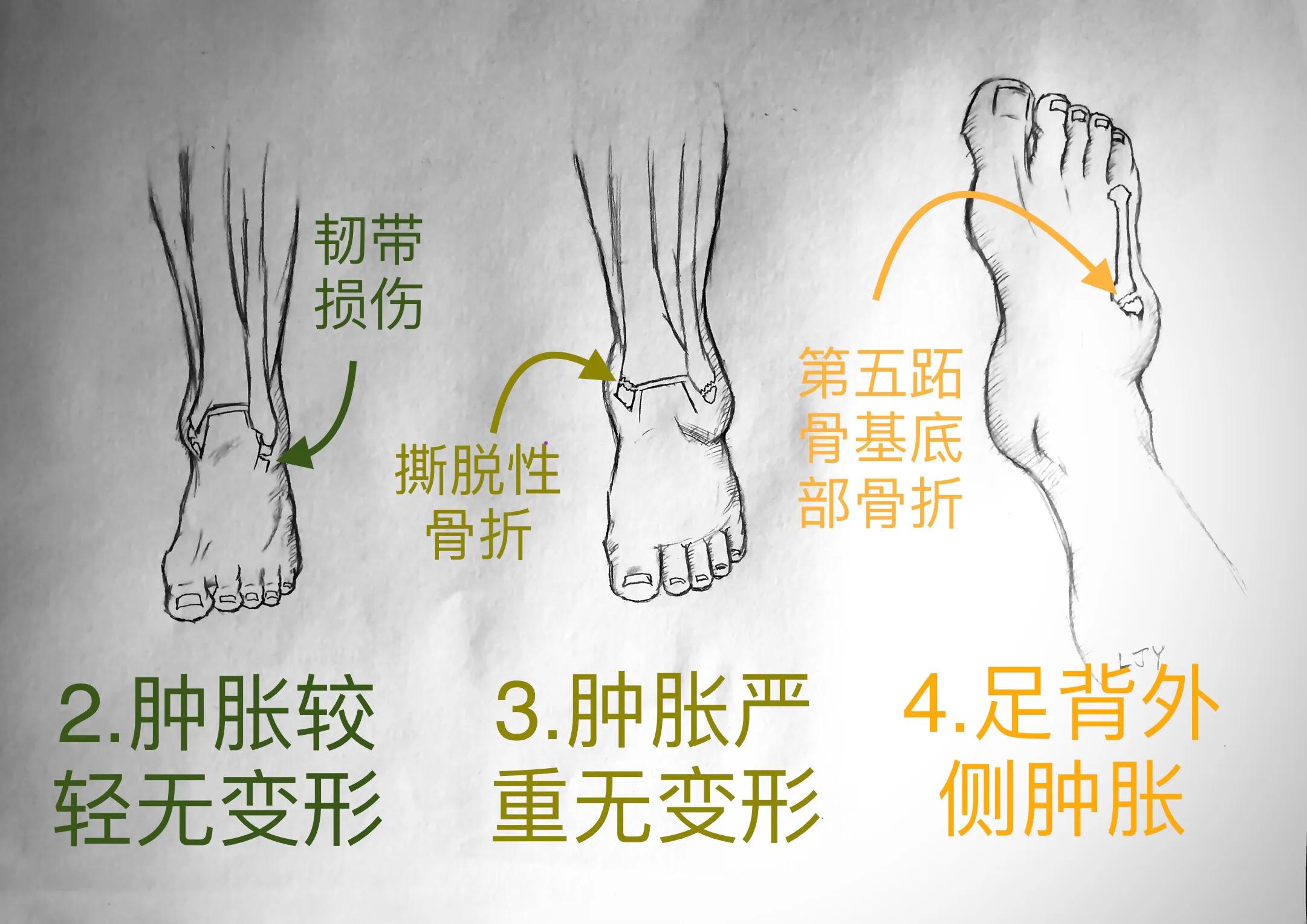 踝关节扭伤后有何表现,踝关节扭伤的自我判断与治疗