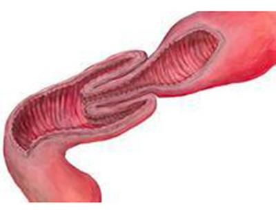 便血可触及腹部包块,肠套叠肚子轻微疼痛