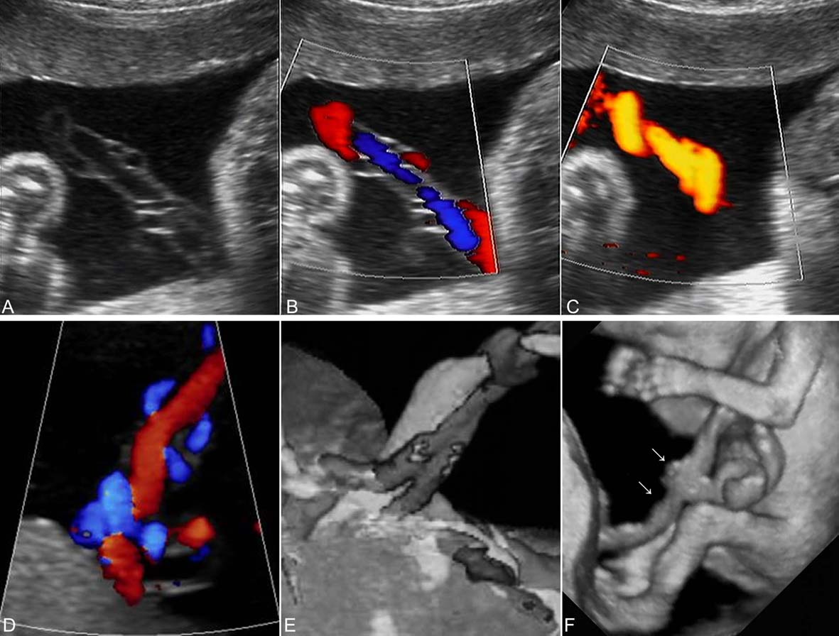 一级超声检查能检查出脐带绕颈吗,脐带超声检查图解