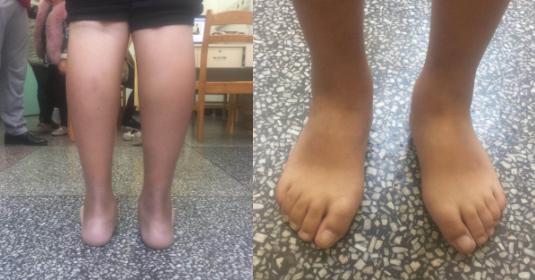 中年人扁平足做微创手术,僵硬型扁平足手术