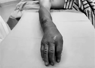 男子烧伤后擦盐水、涂大酱险感染