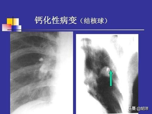 肺结核钙化了还会得肺癌吗,肺结核钙化能再感染肺结核吗