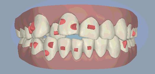 什么叫做矫正牙,什么是牙齿矫正过程