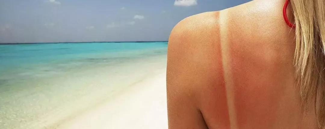 晒伤后绝对不能做的4件事,晒伤修复小妙招你绝对不知道