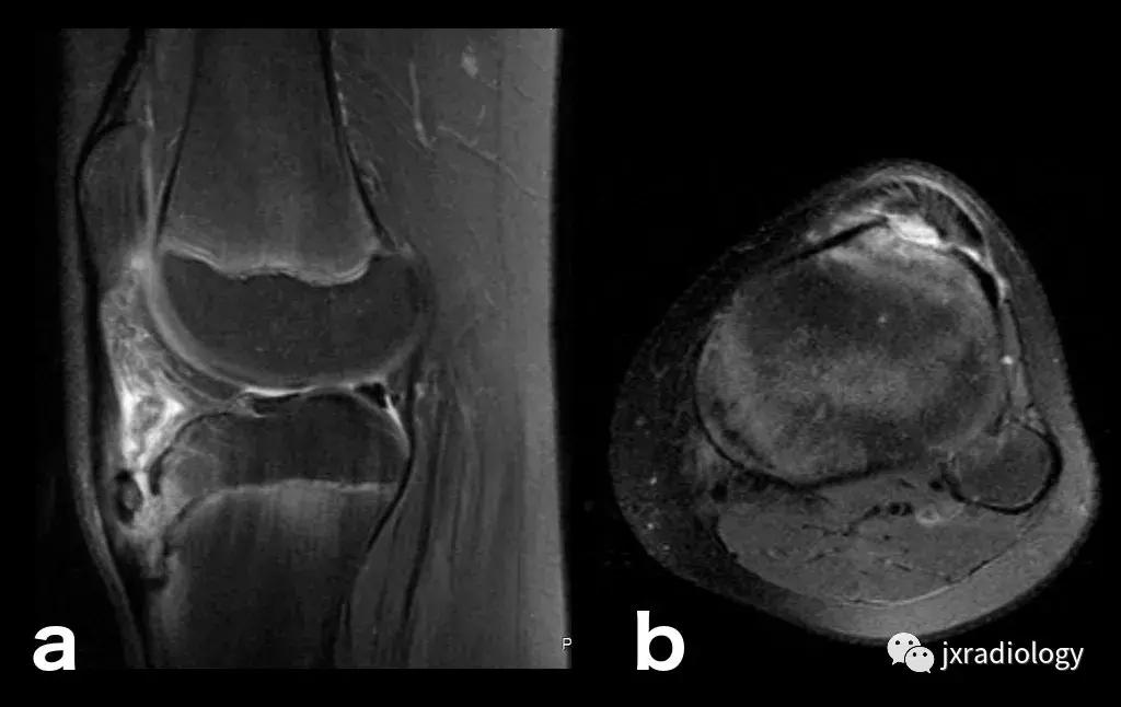 磁共振天天诊断骨髓水肿，但您知道原因吗？