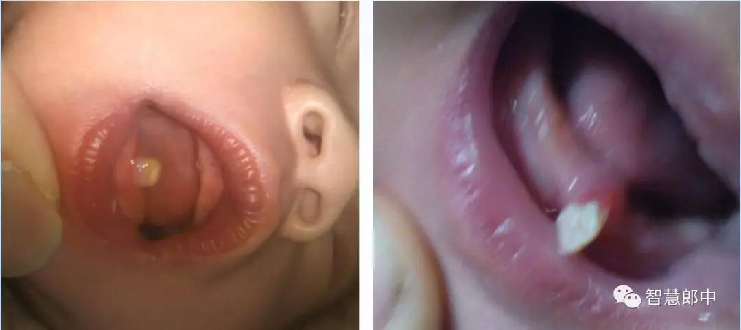 新生儿的几种生理现象图片,新生儿正常生理现象