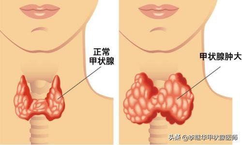 桥本甲状腺炎和甲减的恩怨,甲状腺与碘的恩怨