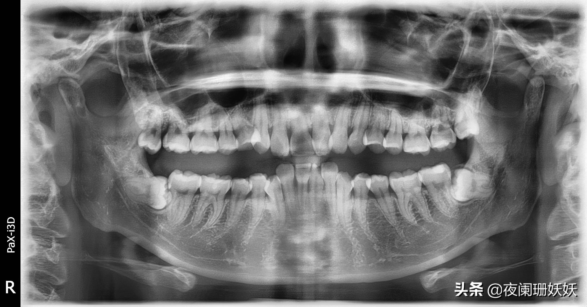 拔智齿横向阻生,拔智齿阻生牙是什么样