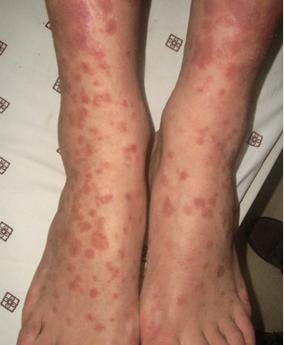 10岁孩子浑身起红点,10岁孩子身上起红点怎么回事