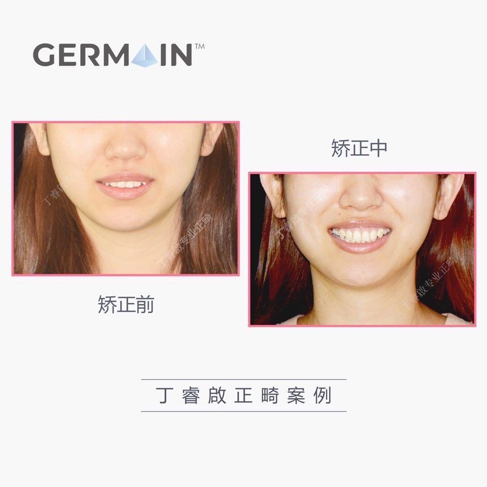 郑州牙齿矫正丁睿啟｜下巴后缩病例合集