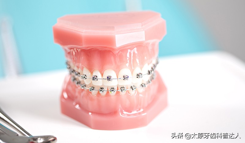 30岁整牙齿矫正多少钱,30岁还能牙齿矫正吗