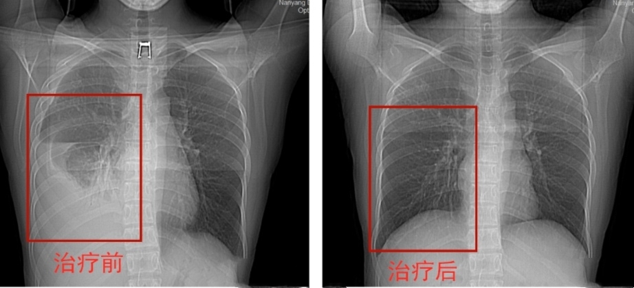 结核性胸膜炎五年后复发几率,得了结核性胸膜炎影响寿命吗