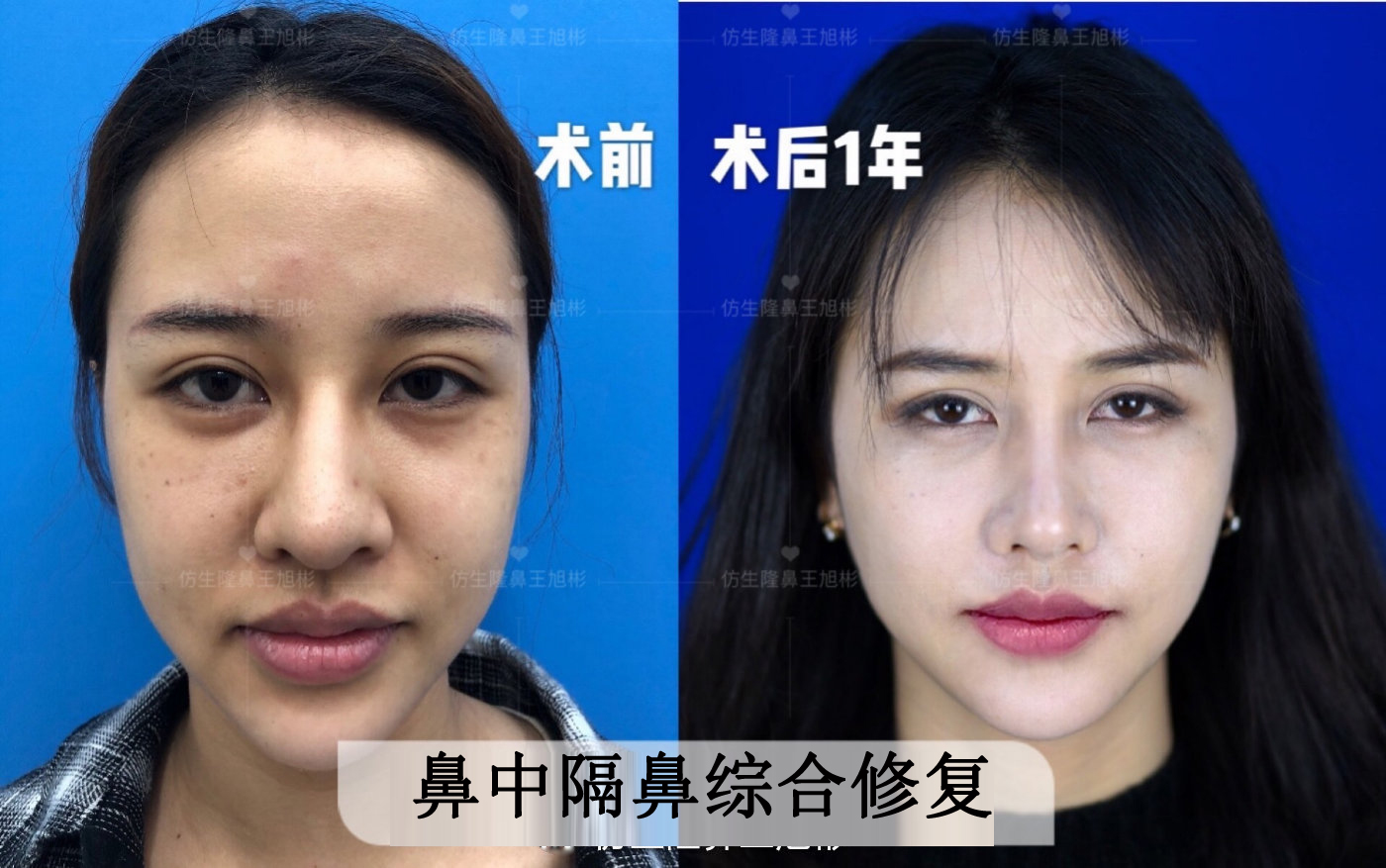 缩鼻翼可以改善鼻翼下垂吗,鼻翼肥大之鼻翼缩小术你见过吗