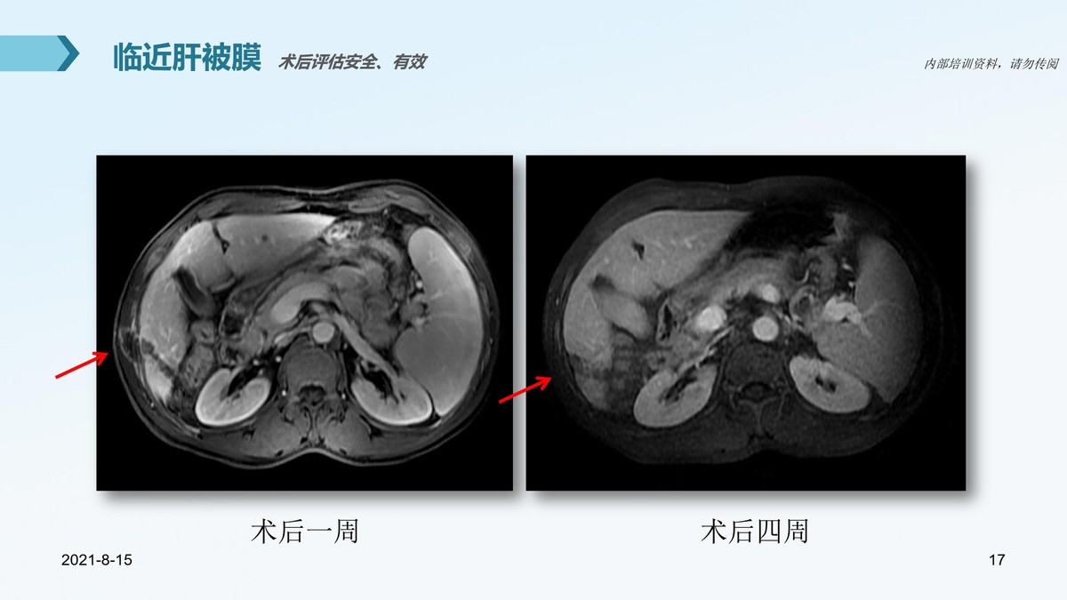 氩氦刀适合早期的肿瘤的切除么,氩氦刀肿瘤治疗新方法