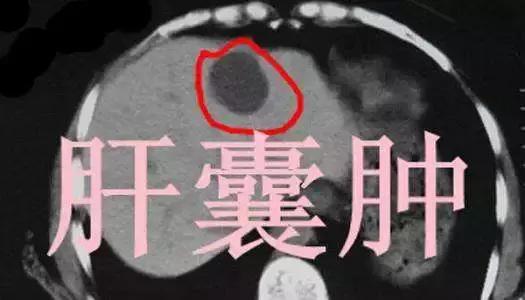吃药可以消除肝囊肿吗,医生教你治好肝囊肿