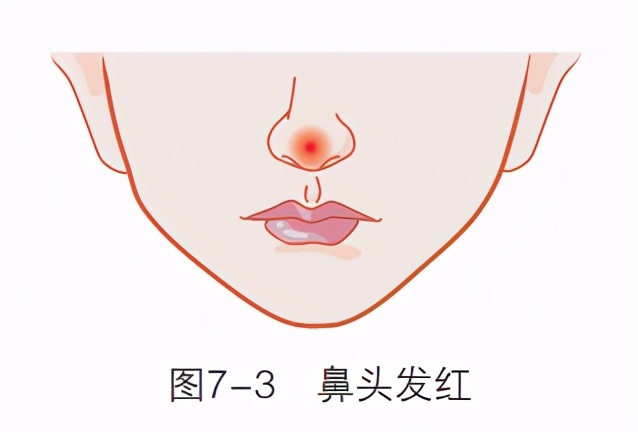 鼻子没嗅觉是梅毒引起的吗,鼻子出现梅毒症状