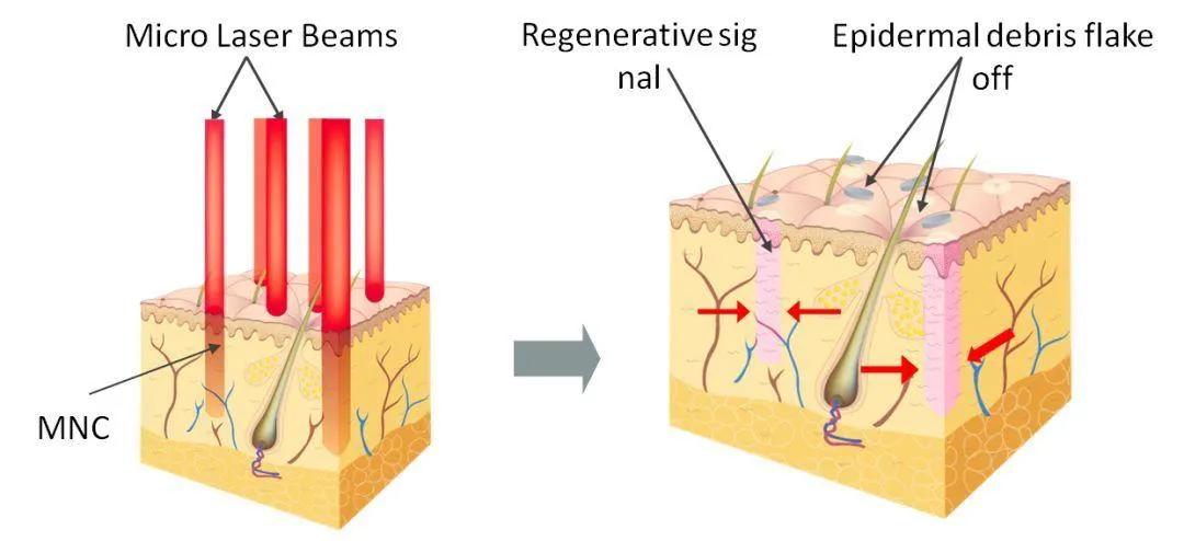 激光照射的注意事项,开关激光