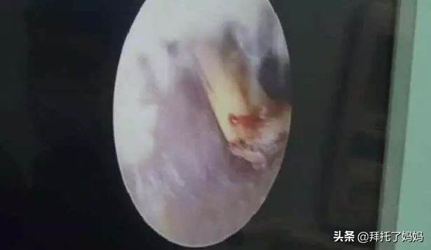 宝宝有耳屎家长一定不能这样做,男孩不掏耳屎进医院