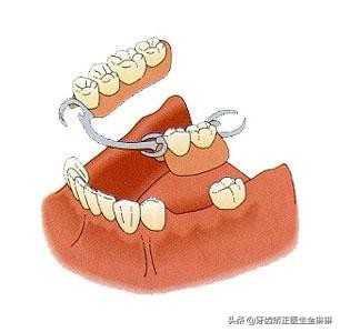 为什么做假牙就牙痛,镶牙几年后假牙下的真牙疼怎么办